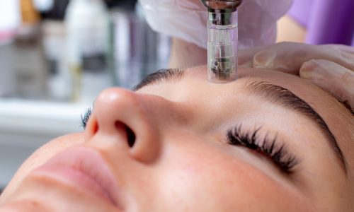 Fractional,Microneedle,Facial,Therapy,Close,Up