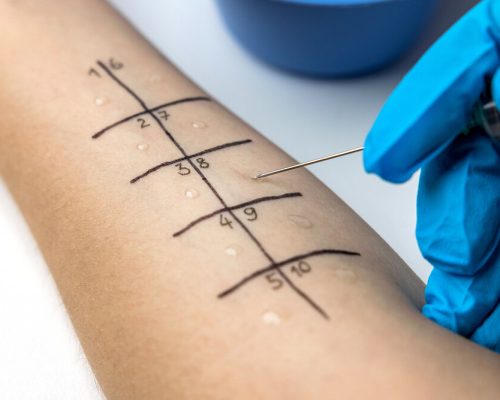 allergist doing skin prick allergy test on a patient arm closeup